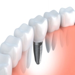 Clínica Dental Roberto H. Manette en Deltamèdic La Ràpita - Implants